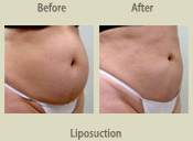 Before & After Photo