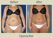 Before & After Photo