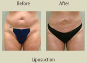 Before & After Photo