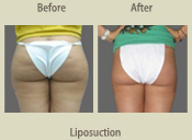 Before & After Photo