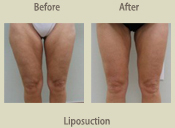 Before & After Photo