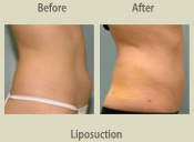 Before & After Photo