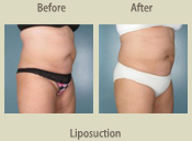 Before & After Photo
