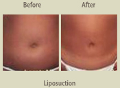 Before & After Photo