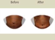 Before & After Photo