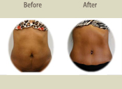 Before & After Photo