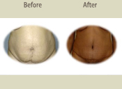 Before & After Photo