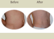 Before & After Photo
