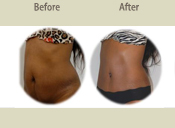 Before & After Photo