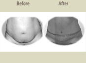 Before & After Photo