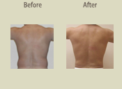 Before & After Photo