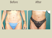 Before & After Photo