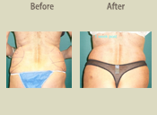 Before & After Photo