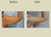 Before & After Photo