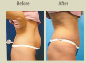 Before & After Photo