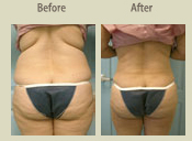 Before & After Photo