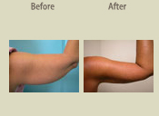 Before & After Photo