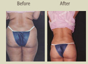 Before & After Photo
