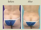 Before & After Photo