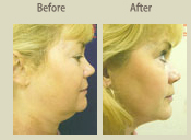 Before & After Photo