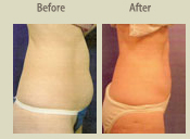 Before & After Photo