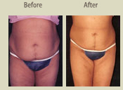 Before & After Photo
