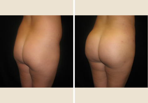 Butt Lift patient Dr. Cole