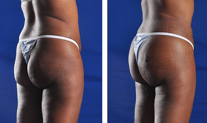 Brazilian Butt Lift by Dr. Hall