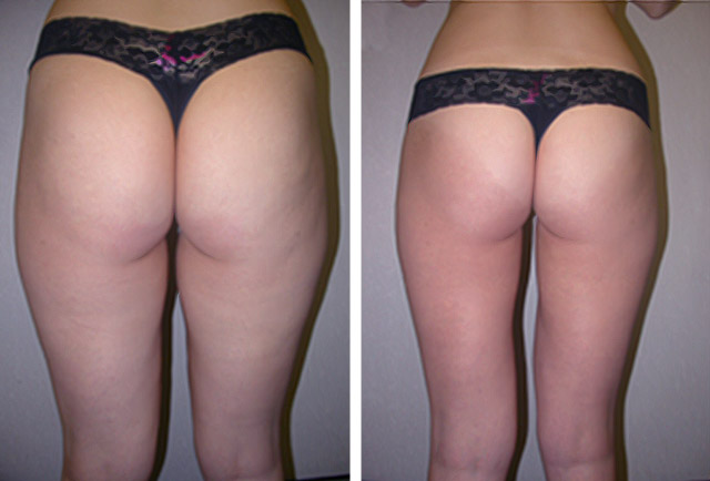 chin liposuction recovery