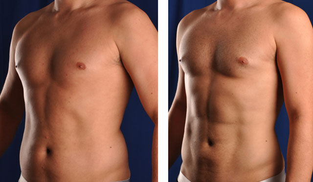 LIPOSUCTION/LASER LIPO/SMART LIPO