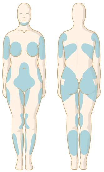 SmartLipo Target Areas