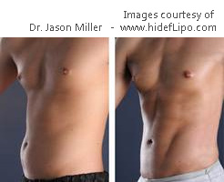 Hi Def Lipo