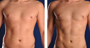 Hi Def Lipo