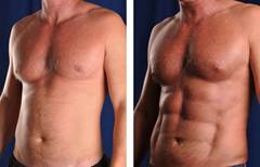 Hi Def Lipo