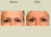 Before & After Photo