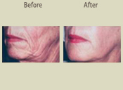 Before & After Photo