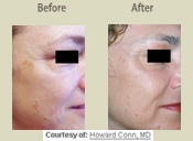 Before & After Photo