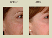 Before & After Photo