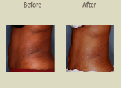 Before & After Photo