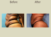 Before & After Photo