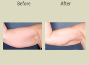 Before & After Photo