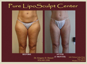 Before & After Photo