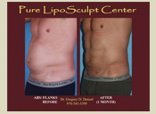 Before & After Photo