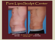 Before & After Photo