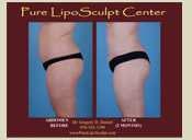 Before & After Photo