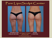 Before & After Photo