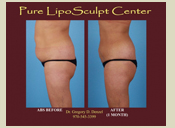 Before & After Photo