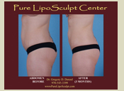 Before & After Photo