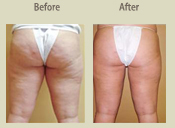Before & After Photo
