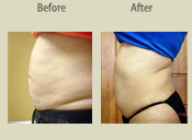 Before & After Photo